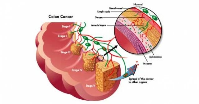 Amebiasis and Colon Cancer: The Potential Connection